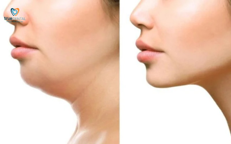 Lợi ích niềng răng cho khuôn mặt thon gọn