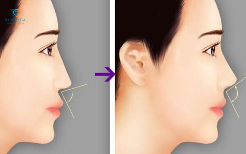 Lợi ích niềng răng cho khuôn mặt thon gọn