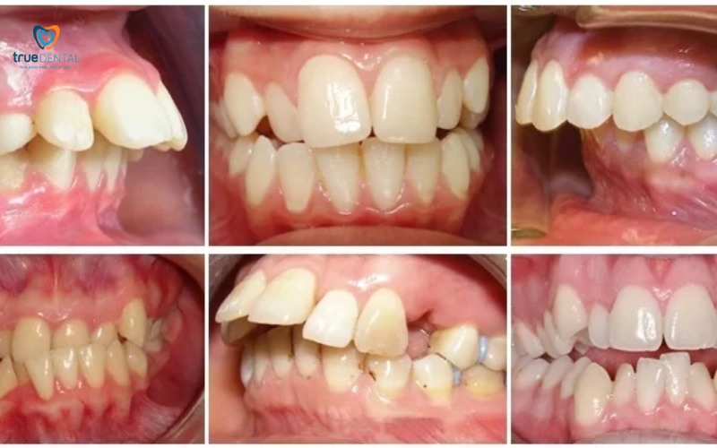 Lợi ích niềng răng cho khuôn mặt thon gọn