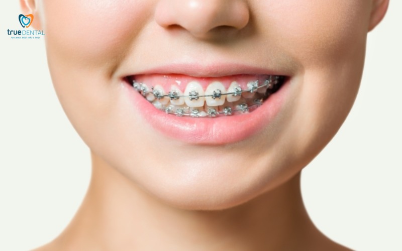 Lợi ích niềng răng cho khuôn mặt thon gọn