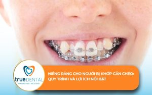 niềng răng cho người bị khớp cắn chéo