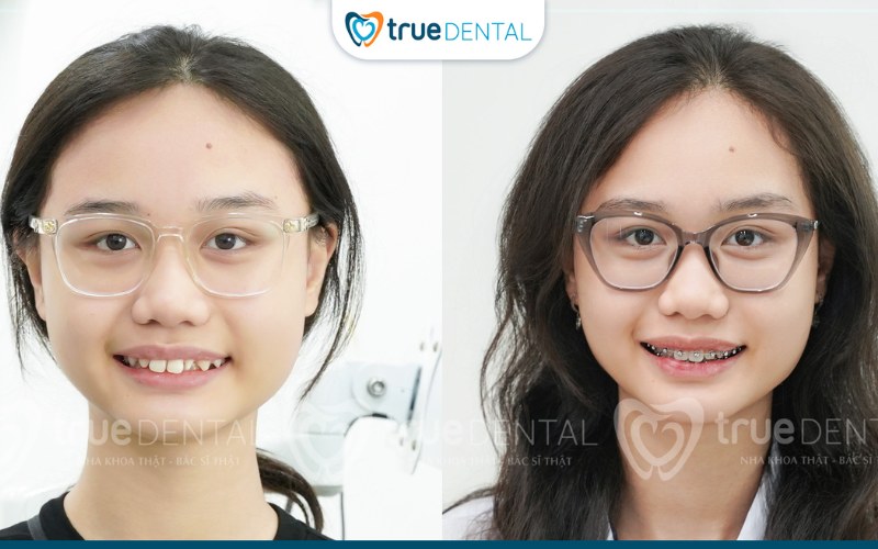 Niềng răng cho người bị khớp cắn chéo: Quy trình và lợi ích nổi bật 9 niềng răng cho người bị khớp cắn chéo