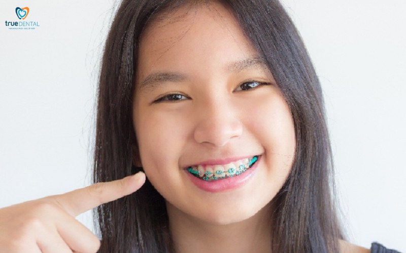 Niềng răng cho người bị khớp cắn chéo: Quy trình và lợi ích nổi bật 11 niềng răng cho người bị khớp cắn chéo