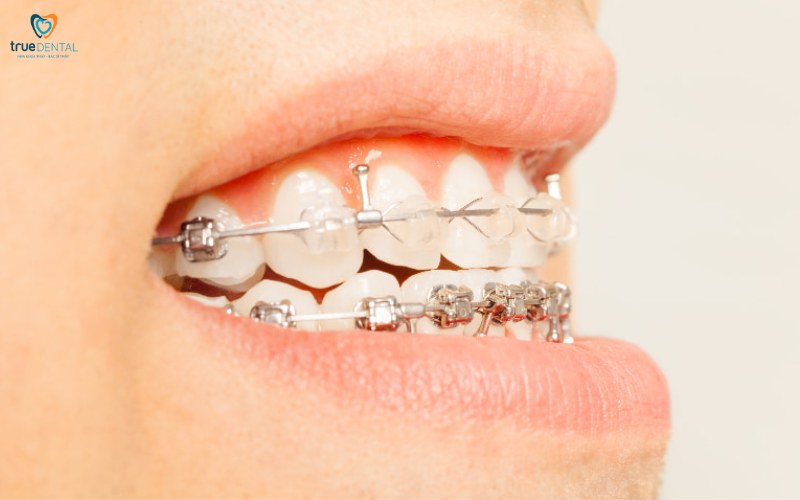 Niềng răng cho người bị khớp cắn chéo: Quy trình và lợi ích nổi bật 2 niềng răng cho người bị khớp cắn chéo