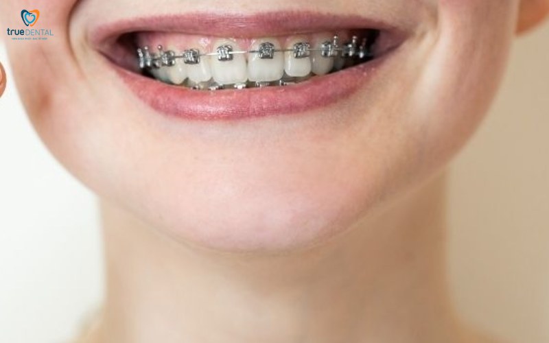 Niềng răng cho người bị khớp cắn chéo: Quy trình và lợi ích nổi bật 3 niềng răng cho người bị khớp cắn chéo