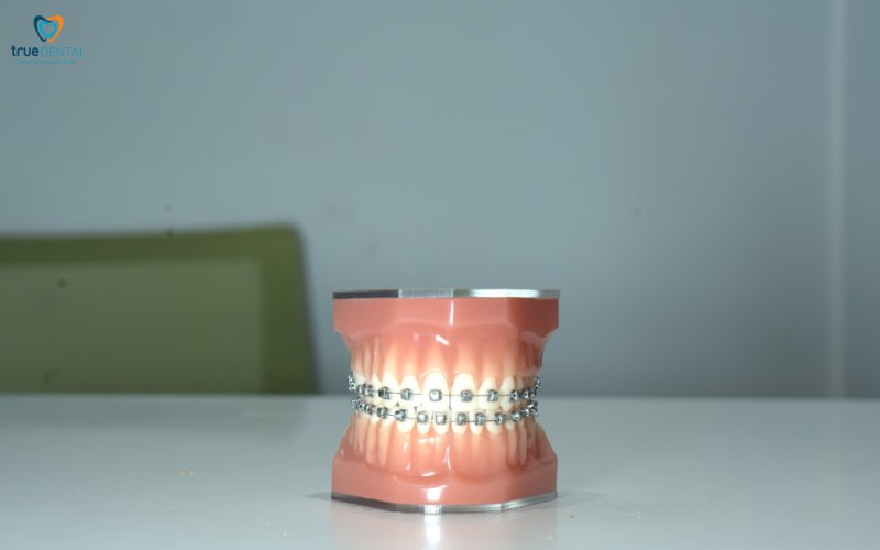 Niềng răng cho người bị khớp cắn chéo: Quy trình và lợi ích nổi bật 7 niềng răng cho người bị khớp cắn chéo