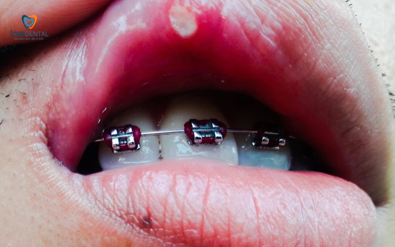 niềng răng có đau khi siết không