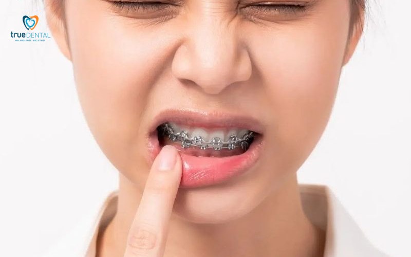 niềng răng có đau khi siết không