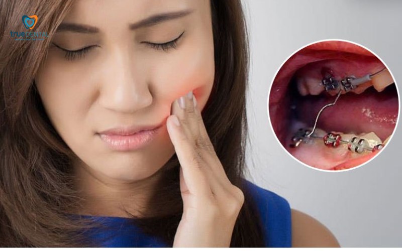 niềng răng có đau khi siết không