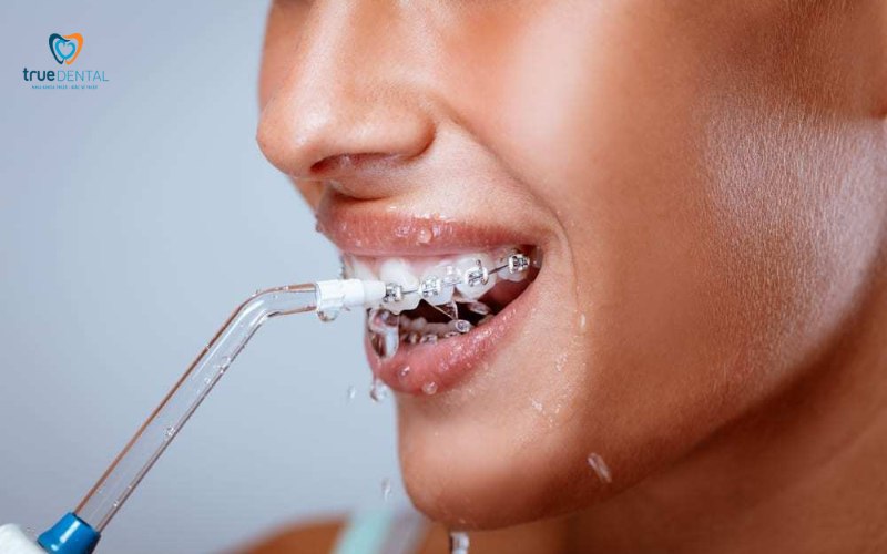 niềng răng có đau khi siết không