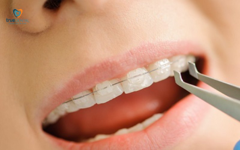 niềng răng có đau khi siết không