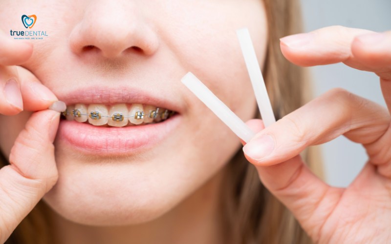 niềng răng có đau khi siết không