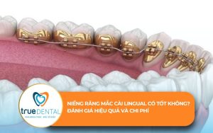 niềng răng mắc cài lingual có tốt không