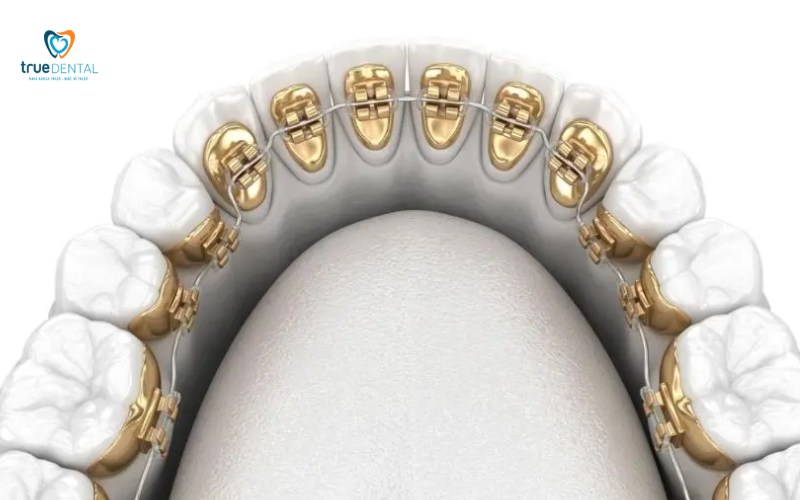 niềng răng mắc cài lingual có tốt không