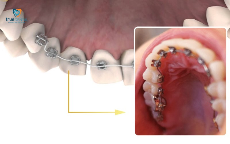 niềng răng mắc cài lingual có tốt không