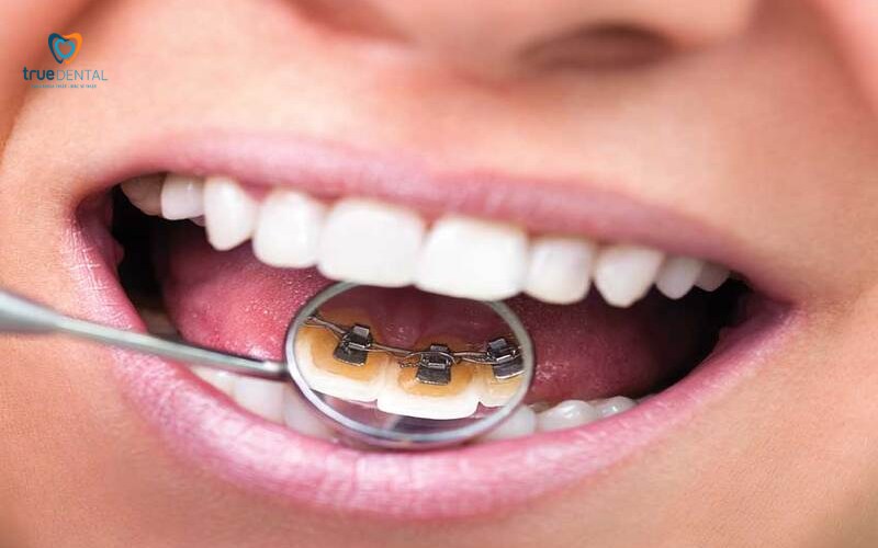 niềng răng mắc cài lingual có tốt không