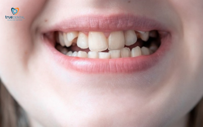 niềng răng mắc cài lingual có tốt không