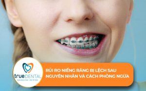 rủi ro niềng răng bị lệch sau