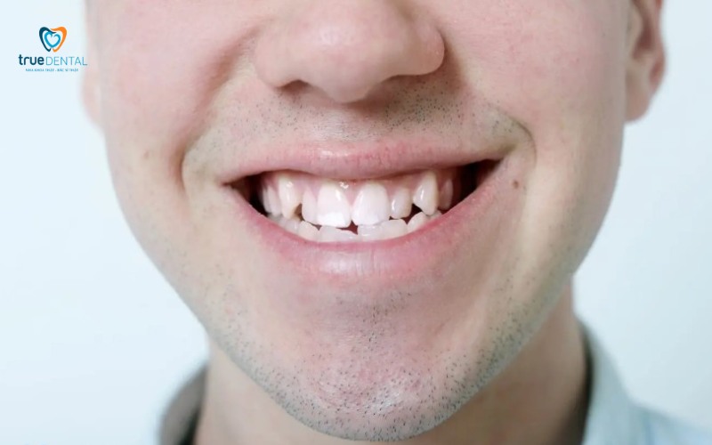 rủi ro niềng răng bị lệch sau