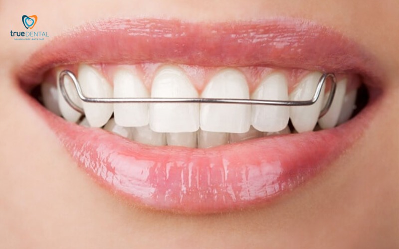 rủi ro niềng răng bị lệch sau