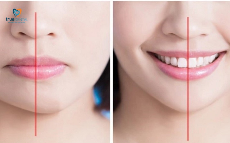 rủi ro niềng răng bị lệch sau