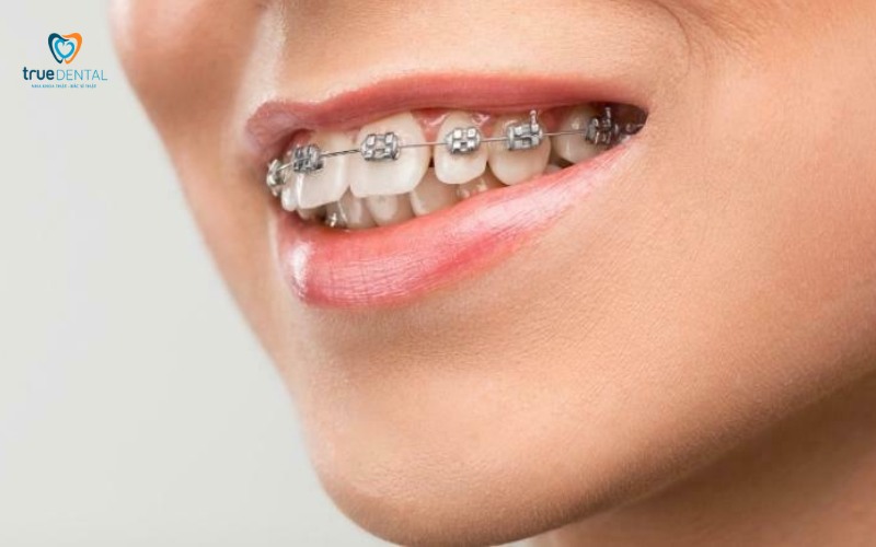 rủi ro niềng răng bị lệch sau