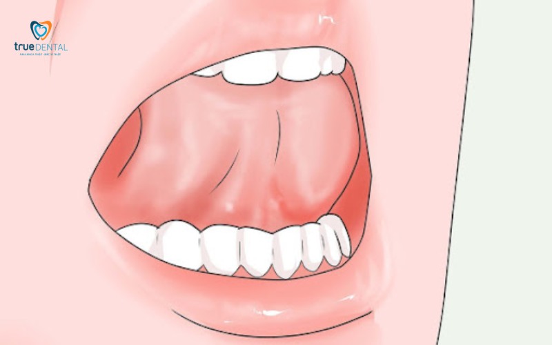 rủi ro niềng răng bị lệch sau