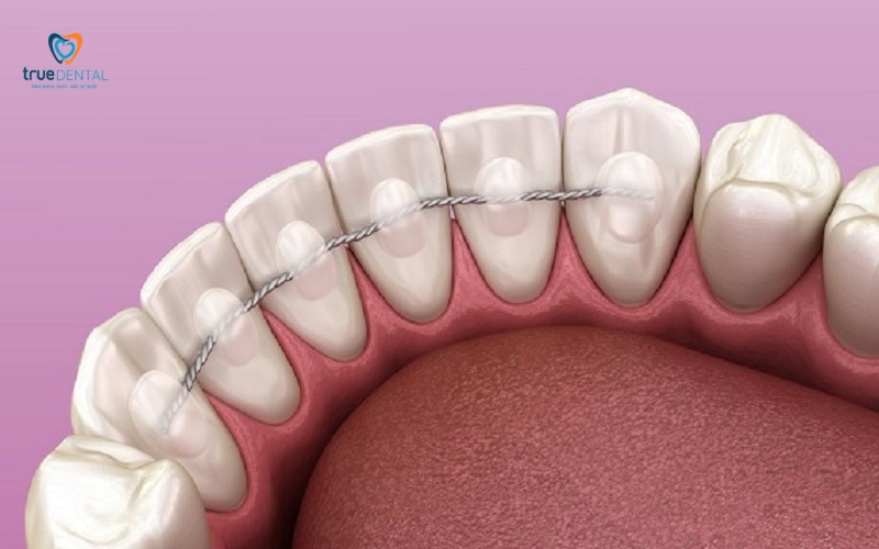 rủi ro niềng răng bị lệch sau