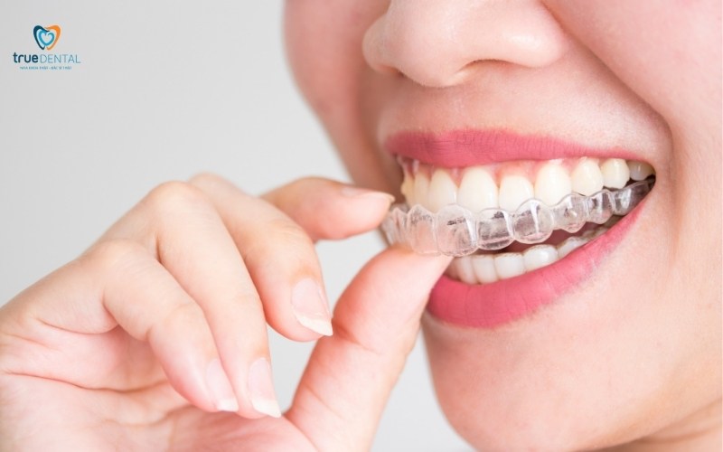 so sánh niềng răng Transalign và mắc cài