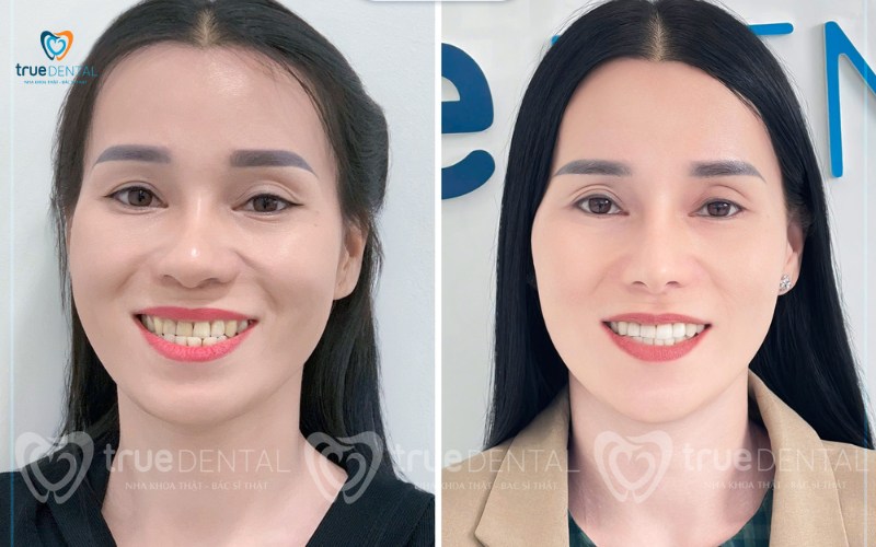 so sánh niềng răng Transalign và mắc cài