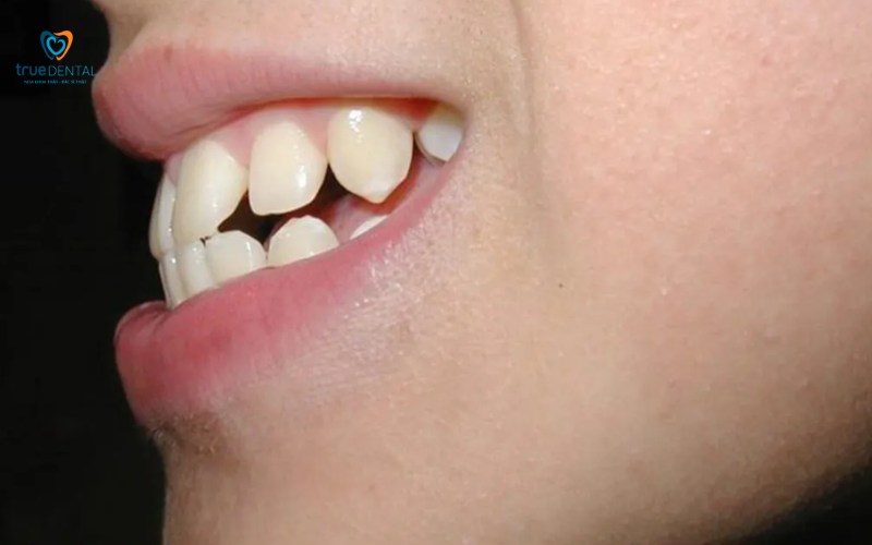 so sánh niềng răng Transalign và mắc cài