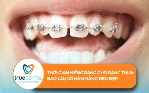 thời gian niềng răng cho răng thưa
