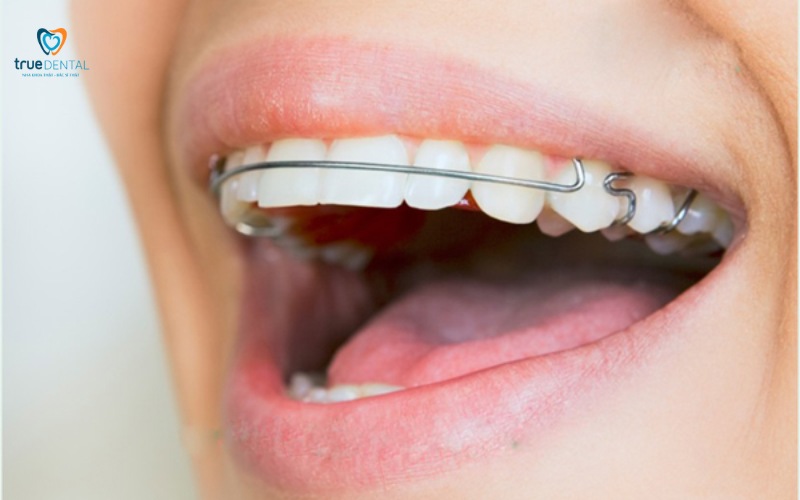 thời gian niềng răng cho răng thưa