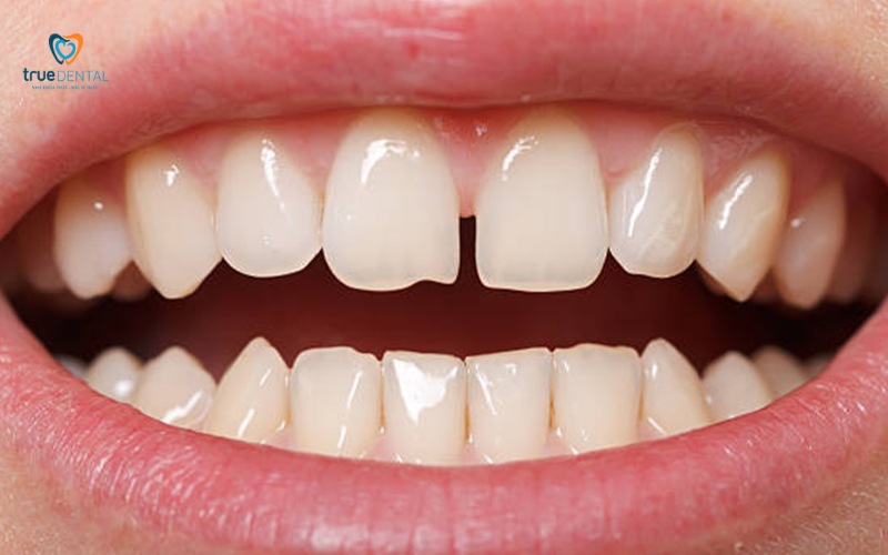 thời gian niềng răng cho răng thưa