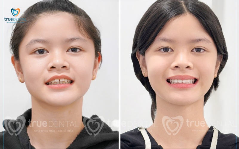 thời gian niềng răng cho răng thưa