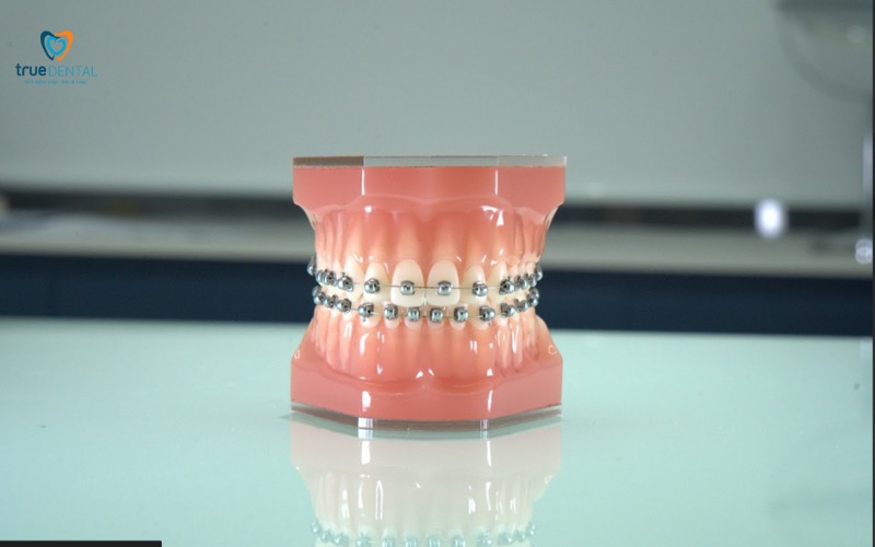 thời gian niềng răng cho răng thưa