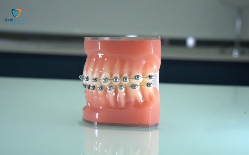 thời gian niềng răng cho răng thưa