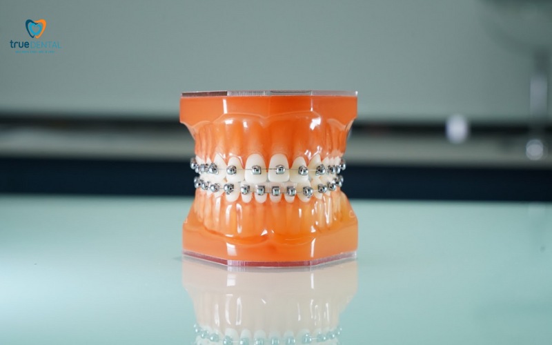 thời gian niềng răng cho răng thưa