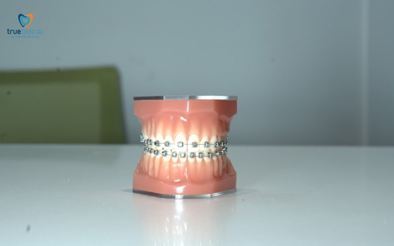 thời gian niềng răng cho răng thưa