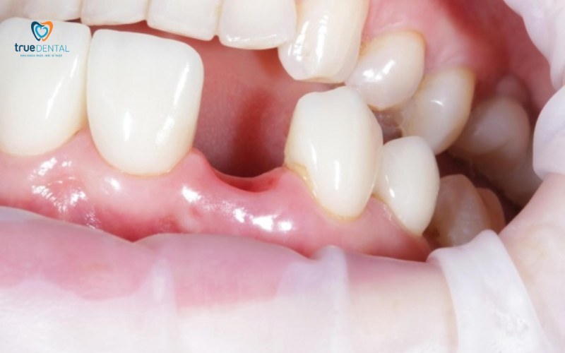 Trụ Implant Dentium Hàn Quốc có tốt không