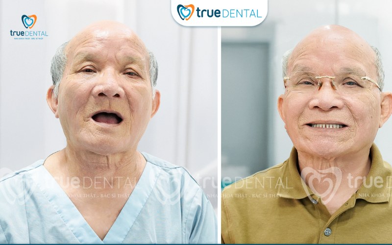 Trụ Implant Dentium Hàn Quốc có tốt không