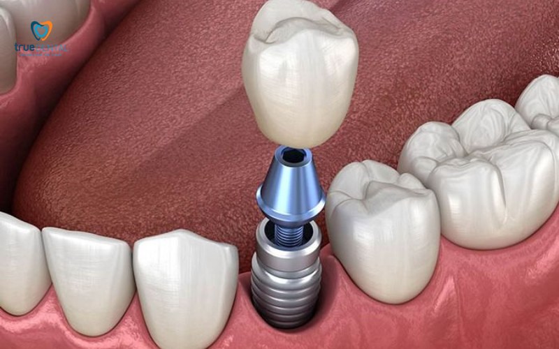 Trụ Implant Dentium Hàn Quốc có tốt không
