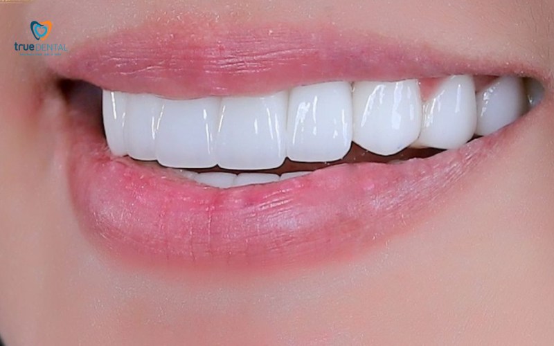 ưu điểm răng sứ nacera