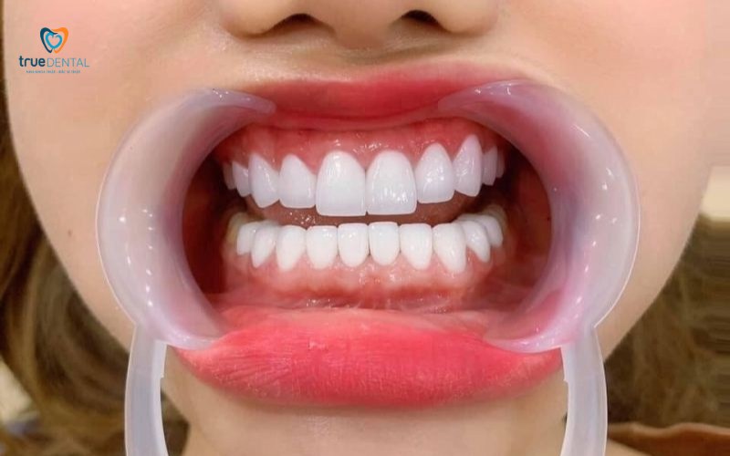 ưu điểm răng sứ nacera