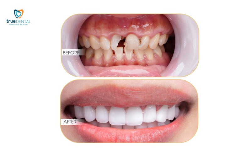 ưu điểm răng sứ nacera