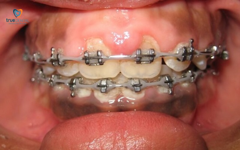 Cách kiểm tra tiến độ niềng răng: Đảm bảo kết quả niềng răng tốt nhất 4 cách kiểm tra tiến độ niềng răng