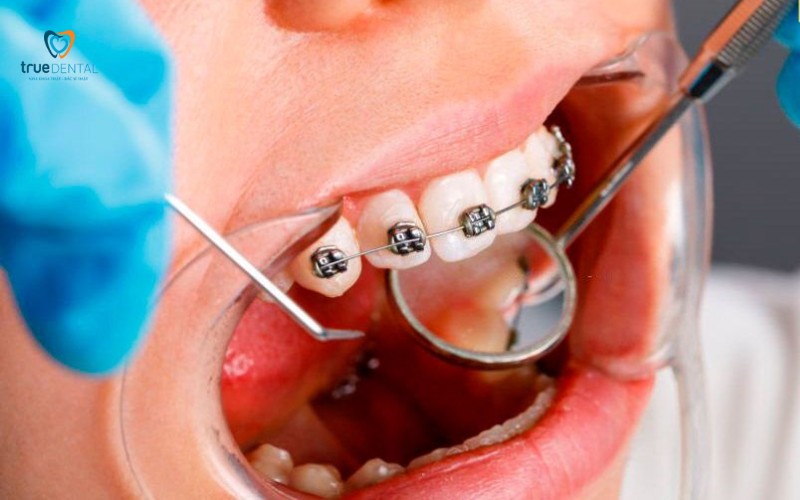 Cách kiểm tra tiến độ niềng răng: Đảm bảo kết quả niềng răng tốt nhất 5 cách kiểm tra tiến độ niềng răng