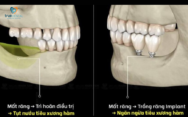 Cấy ghép Implant ở người trẻ tuổi có an toàn