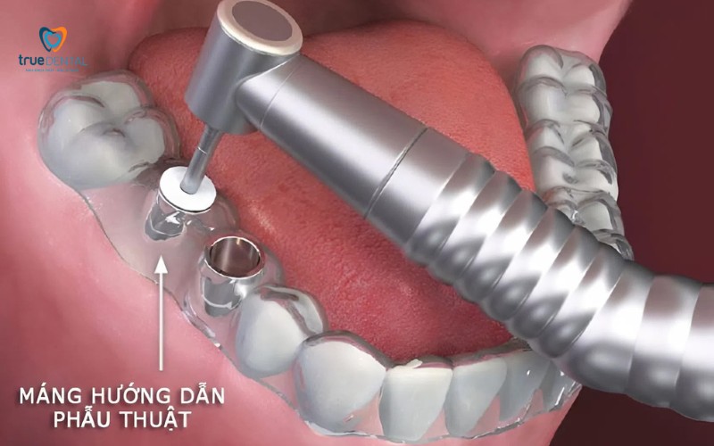 Lợi ích cấy ghép Implant không phẫu thuật