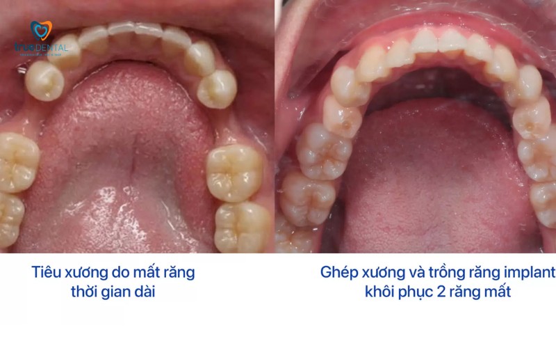 Lợi ích cấy ghép Implant không phẫu thuật